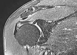 Shoulder Impingement