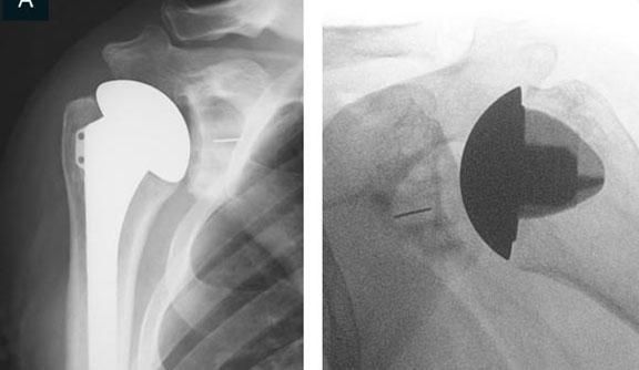 X-ray of a shoulder showing a shoulder replacement implant before and after alignment comparison