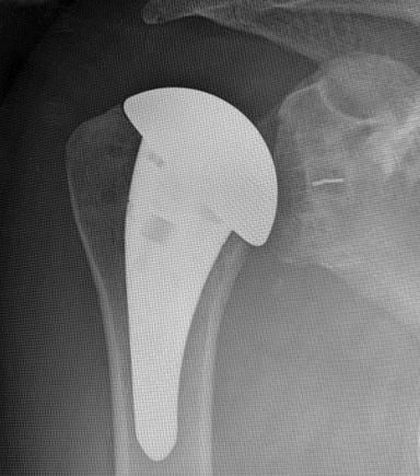 Anatomical replacement