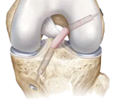 Knee joint anatomy showing an ACL reconstruction graft and surgical drill tunnel