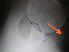 X-ray of a joint with dashed purple outlines and an orange arrow pointing to a bone area