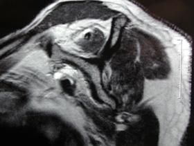 Rotator Cuff Arthritis
