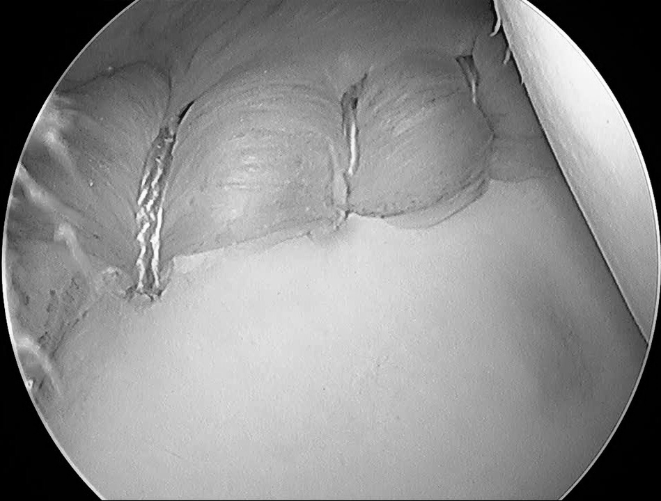Close-up black-and-white medical scan showing a curved organ surface with stitched tissue or surgical repair.