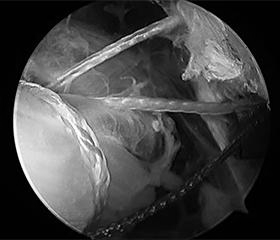 Sutures are tied on the top side of the tendon.