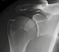 X-ray of a shoulder showing a proximal humerus fracture