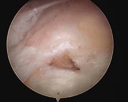 A degenerate, frayed, dislocated or inflamed long head of bicep tendonitis is usually removed from the joint.