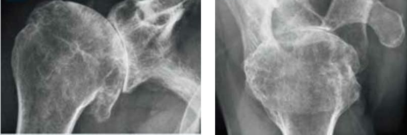 Shoulder Osteoarthritis: with bone-on-bone contact.