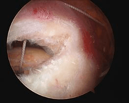A degenerate, frayed, dislocated or inflamed long head of bicep tendonitis is usually removed from the joint. 