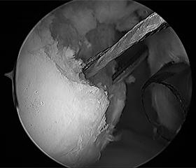 Anchors are placed into the Hill-Sachs defect.