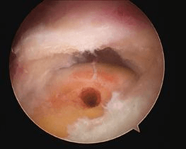 A degenerate, frayed, dislocated or inflamed long head of bicep tendonitis is usually removed from the joint.