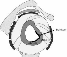 Annotated shoulder MRI diagram showing the labrum and a bankart lesion.