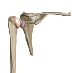 Shoulder joint anatomy showing a dislocated humeral head with torn ligaments in red