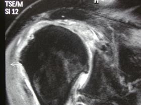 Rotator Cuff Arthritis