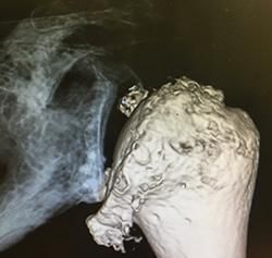3D medical scan showing a large irregular mass near bone in a dark grayscale X-ray image