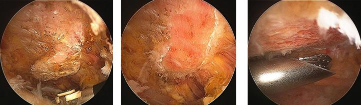 Small plastic anchors are screwed into the humeral insertion of the rotator cuff.