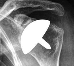X-ray of a shoulder with a white shoulder implant in place