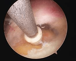 A degenerate, frayed, dislocated or inflamed long head of bicep tendonitis is usually removed from the joint. 