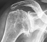 X-ray of a shoulder joint showing severe degenerative changes and bone spurs