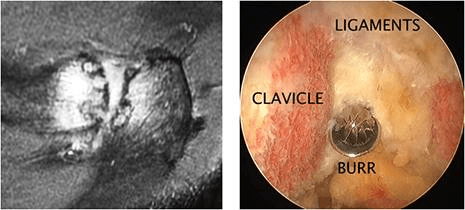 A degenerate, frayed, dislocated or inflamed long head of bicep tendonitis is usually removed from the joint. 