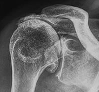 X-ray of a shoulder joint showing degenerative changes and bone spurs
