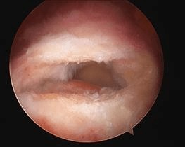 A degenerate, frayed, dislocated or inflamed long head of bicep tendonitis is usually removed from the joint. 
