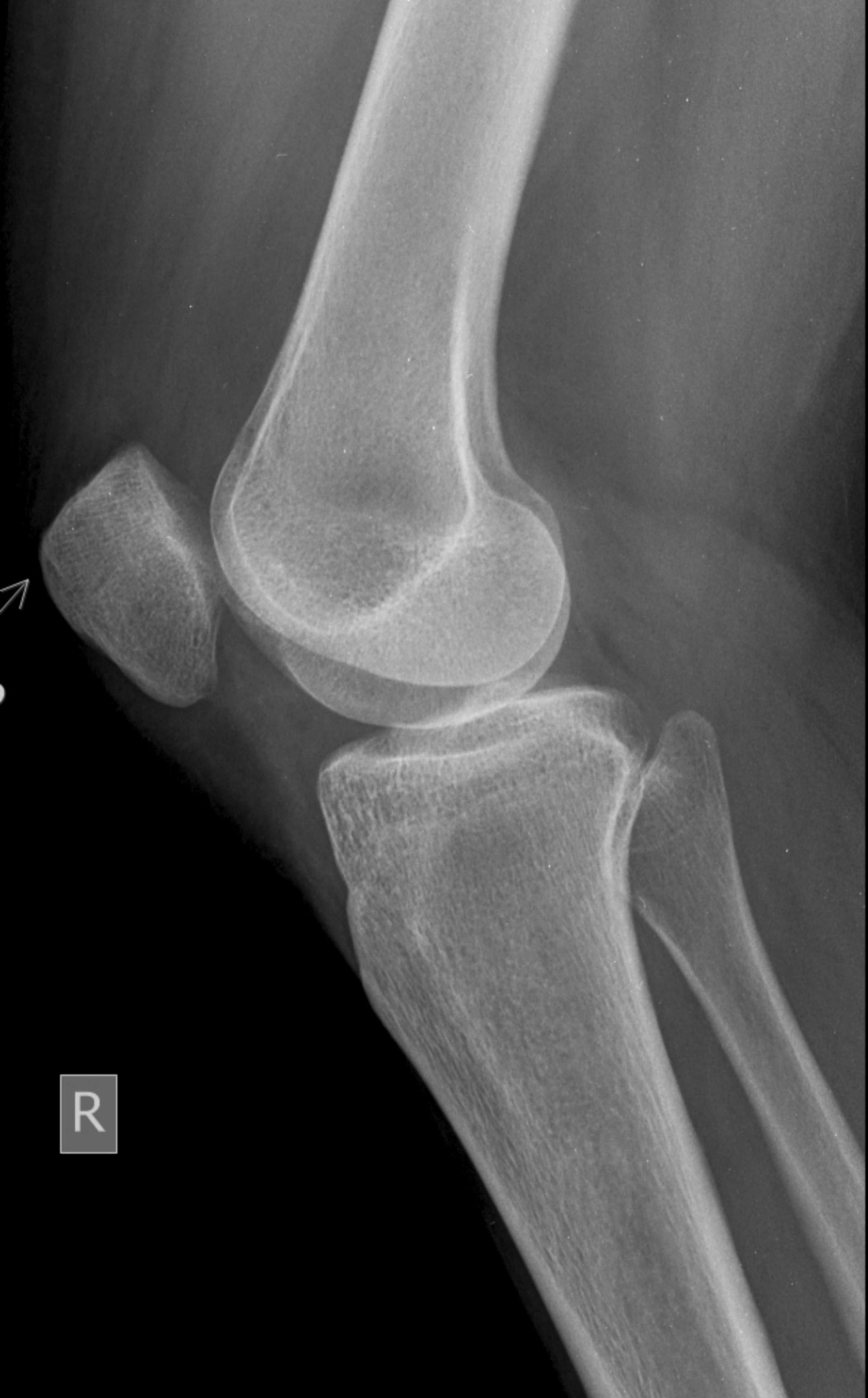 Lateral X-ray of a right knee joint showing the femur, tibia, and patella.