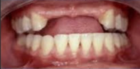 DIENTES ANTES
