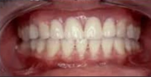 DIENTES DESPUES