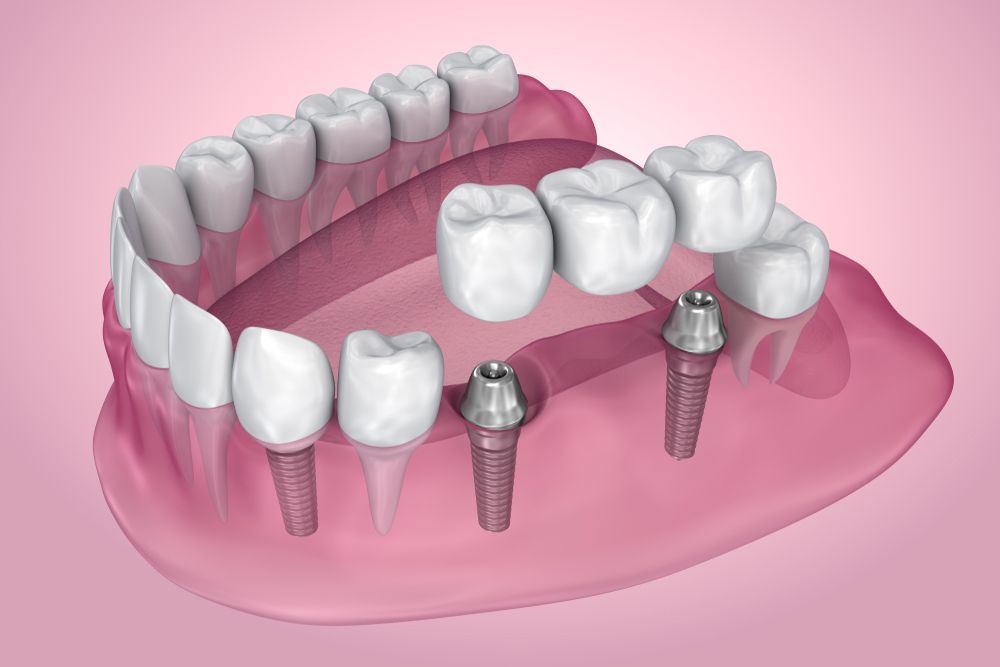 Dental Bridge Illustration — Dental Services in Berserker, QLD