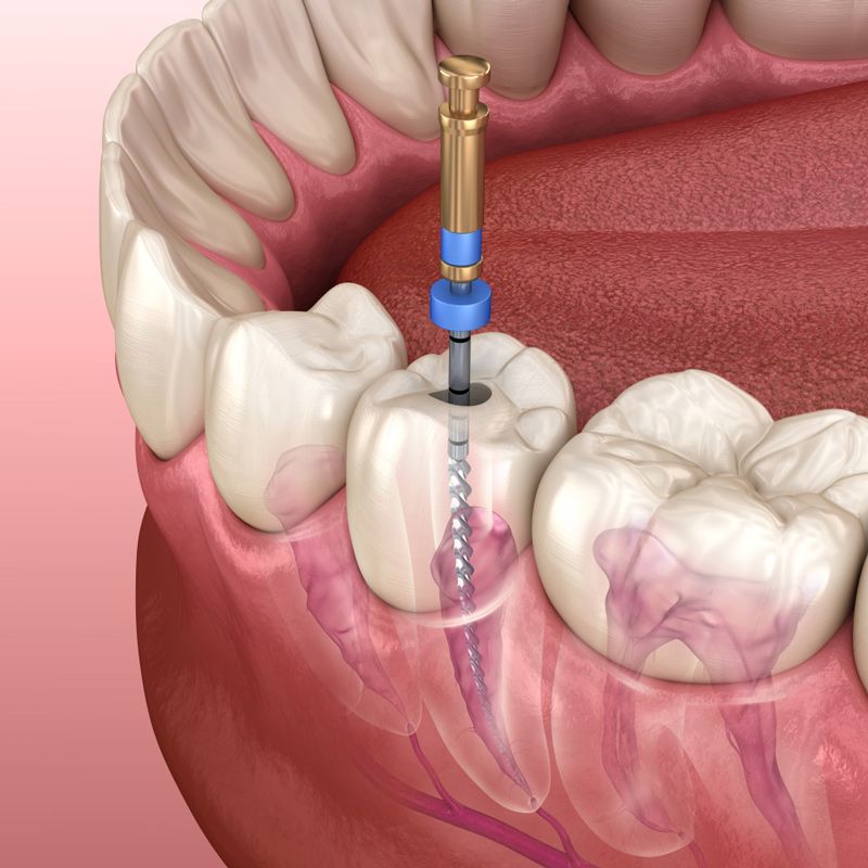 Root Canal Process — Dental Services in Berserker, QLD