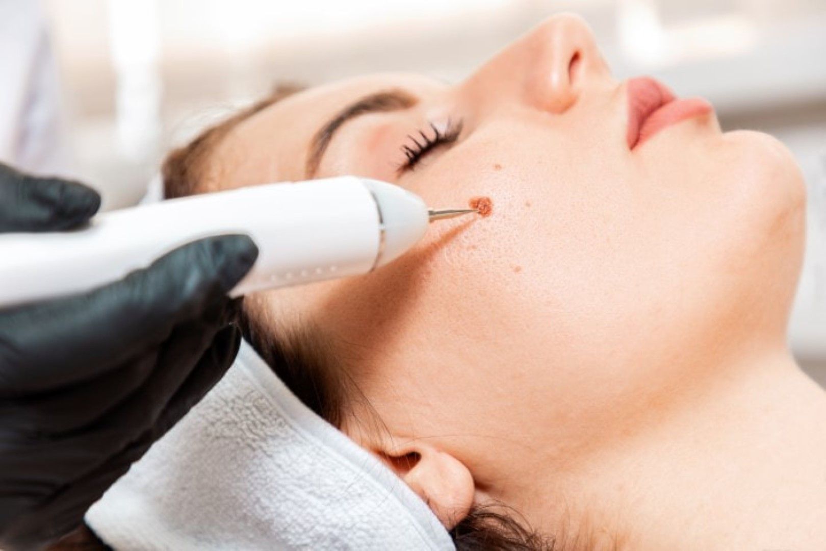 Cryo Skin Tightening