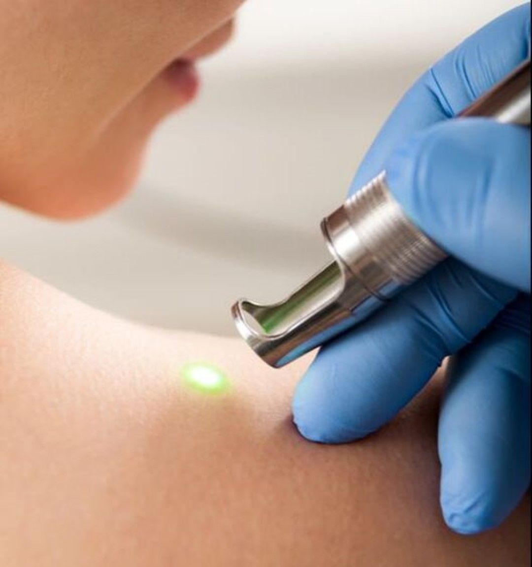 PRP ( Platelet Rich Plasma)