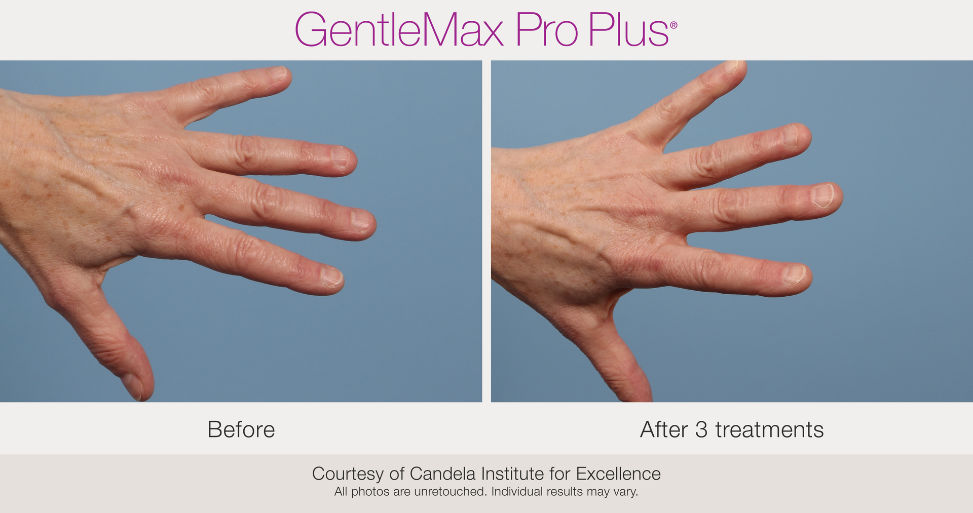 Nail Treatment