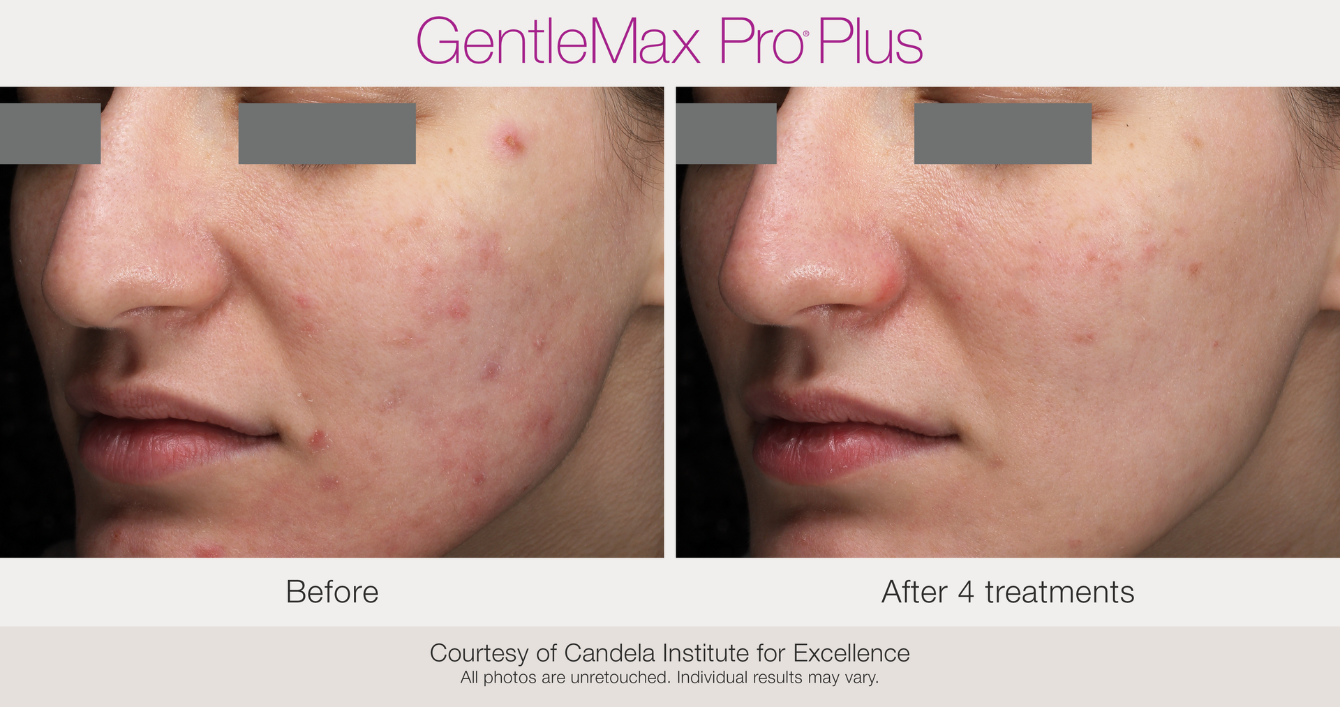Acne Treatment