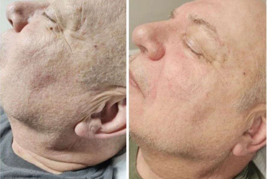 PRX Derm Prefexion