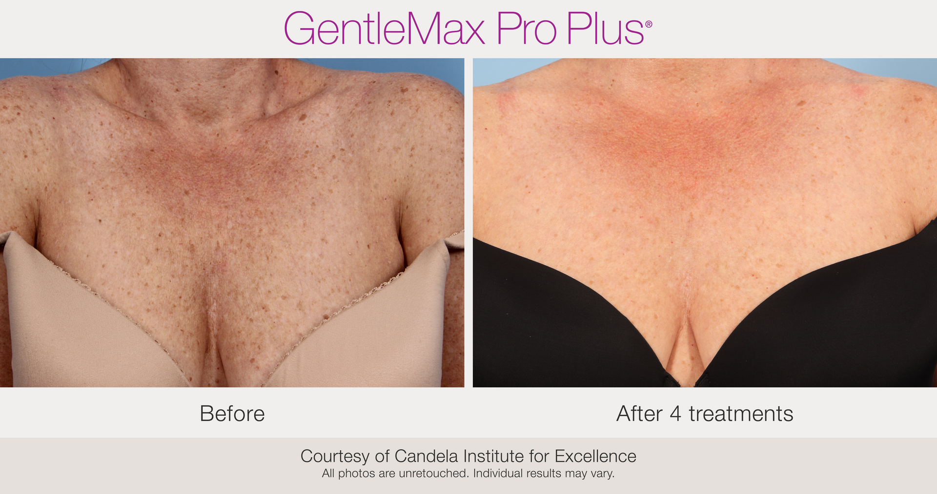Benign Pigmentation Removal
