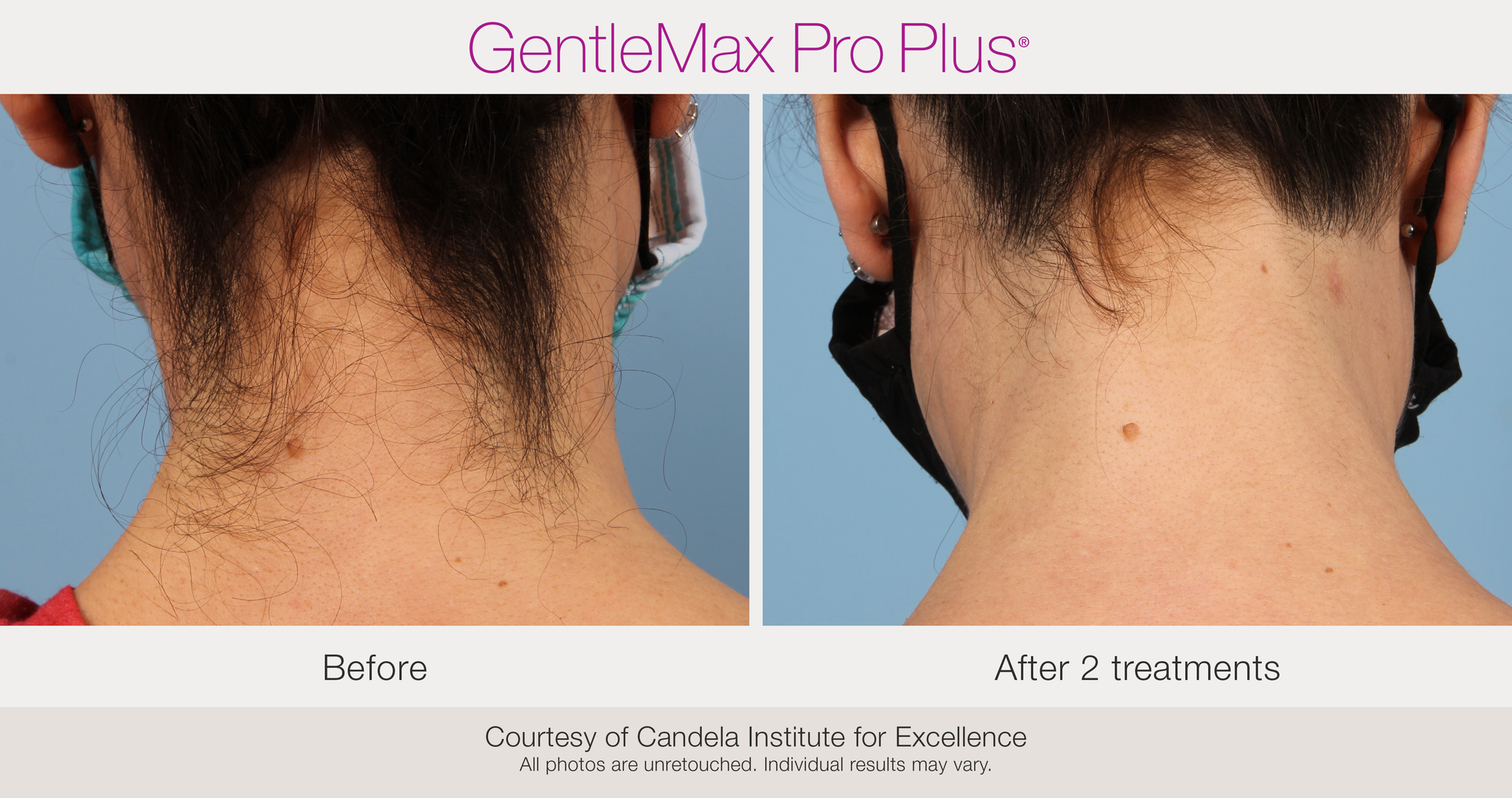 Before and After Laser Hair Removal