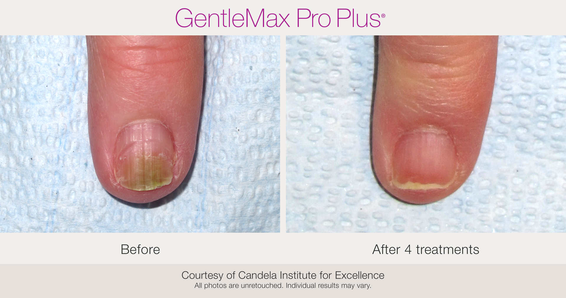 Nail Discoloration Treatment