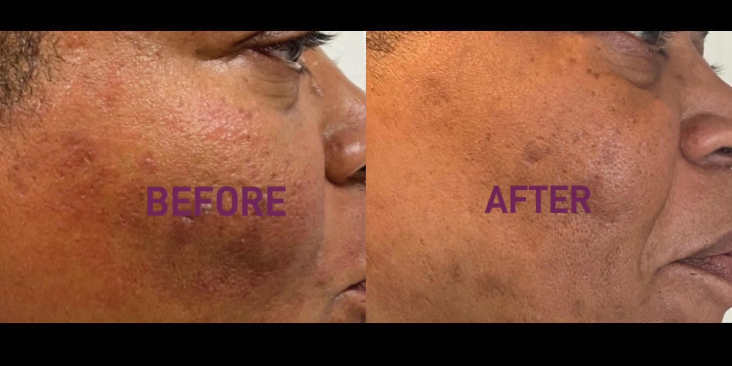 PRX Derm Perfexion
