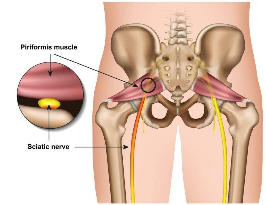 A Diagram of the Piriformis Muscle and Sciatic Nerve — Anderson Family Chiropractic Health Centre in Mount Pleasant, QLD