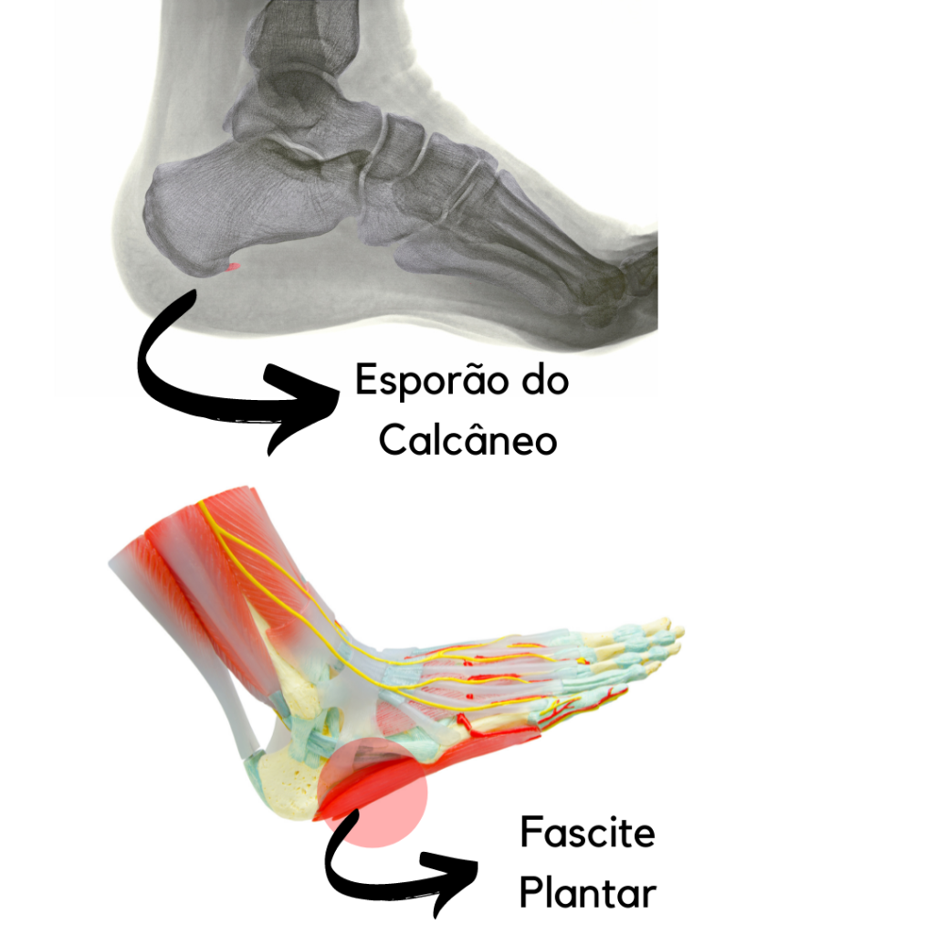 Fascite Plantar e Esporão do Calcâneo: causas e tratamento