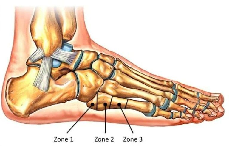 fratura do 5º metatarsal
