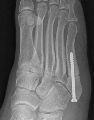 Fratura do 5º Metatarsal