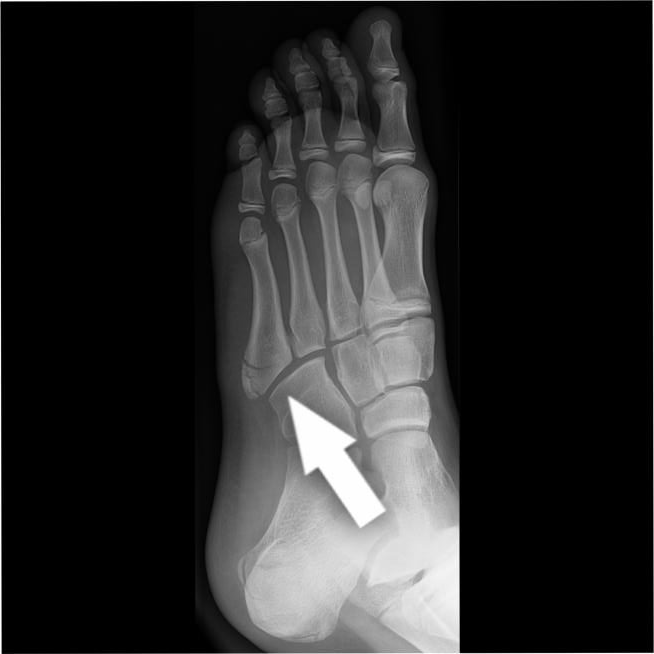 Fratura do 5º Metatarsal