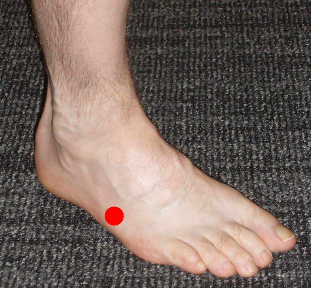 Fratura do 5º Metatarsal