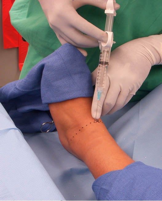 infiltração artrose do tornozelo