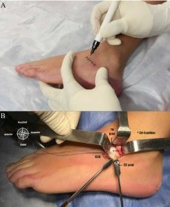 cirurgia barra óssea