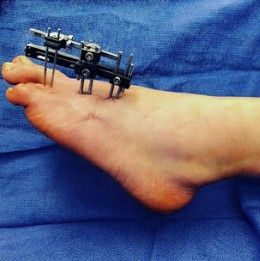 Braquimetatarsia cirurgia