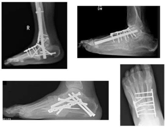 cirurgia pé de charcot