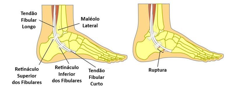Tendinopatia dos tendões fibulares